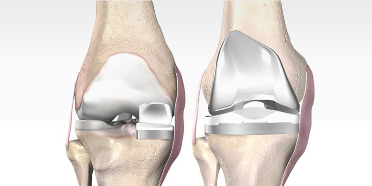 Unicondylar Knee Replacement in early Osteoarthritis knee - An alternative to Total Knee Replacement